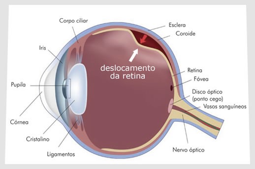 anatomia do olho humano em caso de deslocamento de retina.