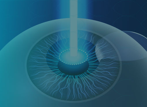 Leia mais sobre o artigo Cirurgia para Presbiopia a Laser