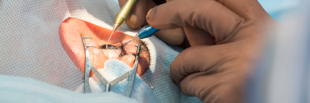Cirurgia de Catarata