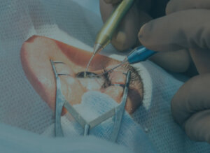 Cirurgia de Catarata