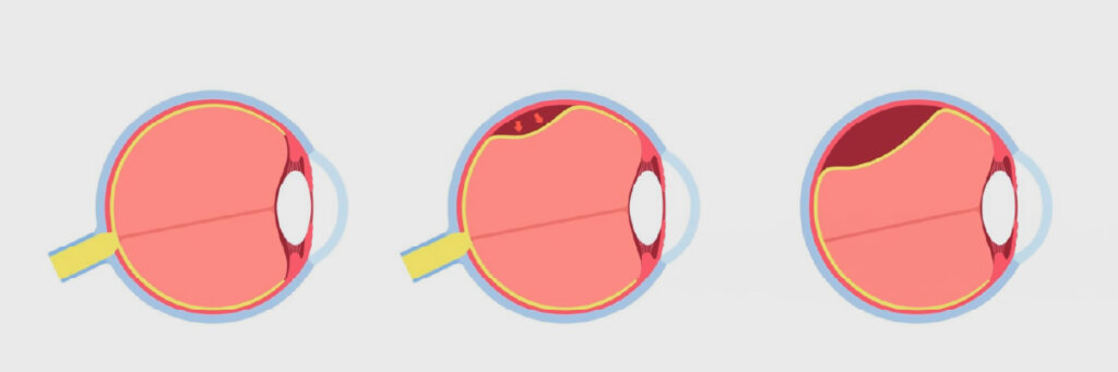 Descolamento de Retina