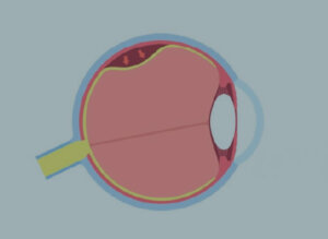 Descolamento de Retina