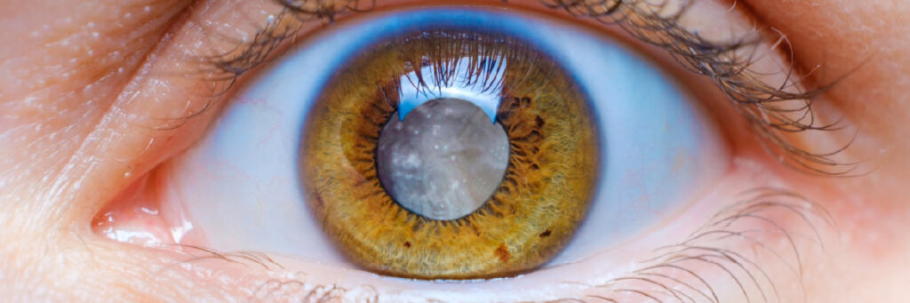 Catarata nos Olhos