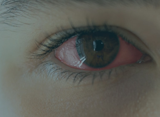 Leia mais sobre o artigo Ceratite