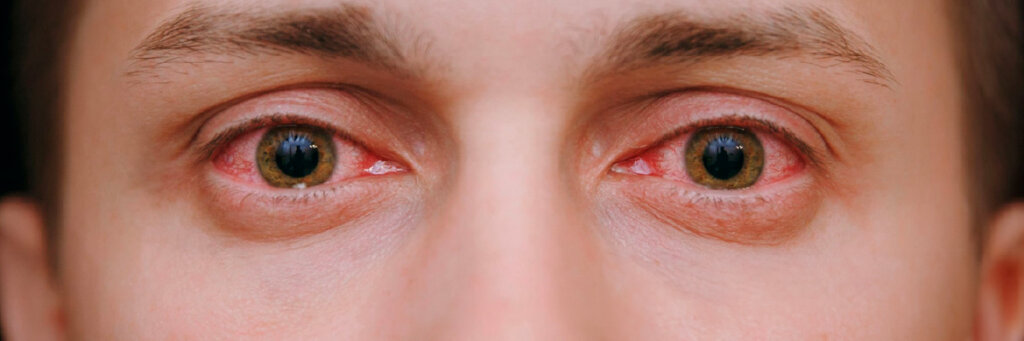 Olho Seco Evaporativo, Menopausa e Reposição Hormonal