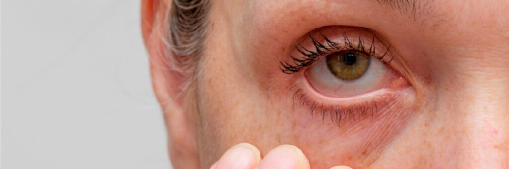 Olho Seco Evaporativo, Menopausa e Reposição Hormonal