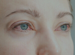 Alergias Oculares no Inverno