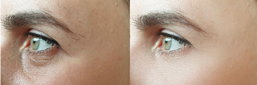 Melhor Cirurgião para Blefaroplastia