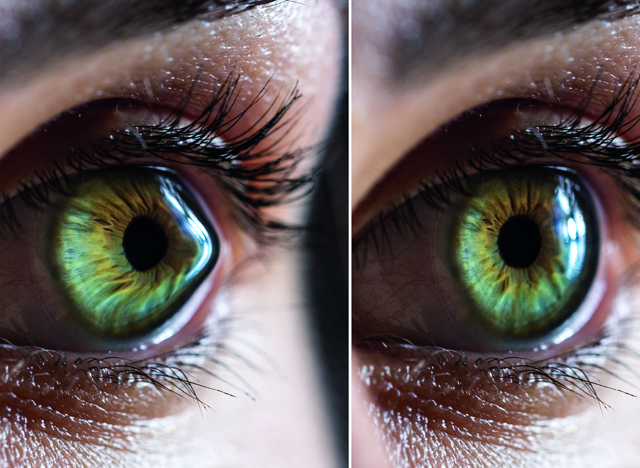 Leia mais sobre o artigo Ceratocone Tem Cura?