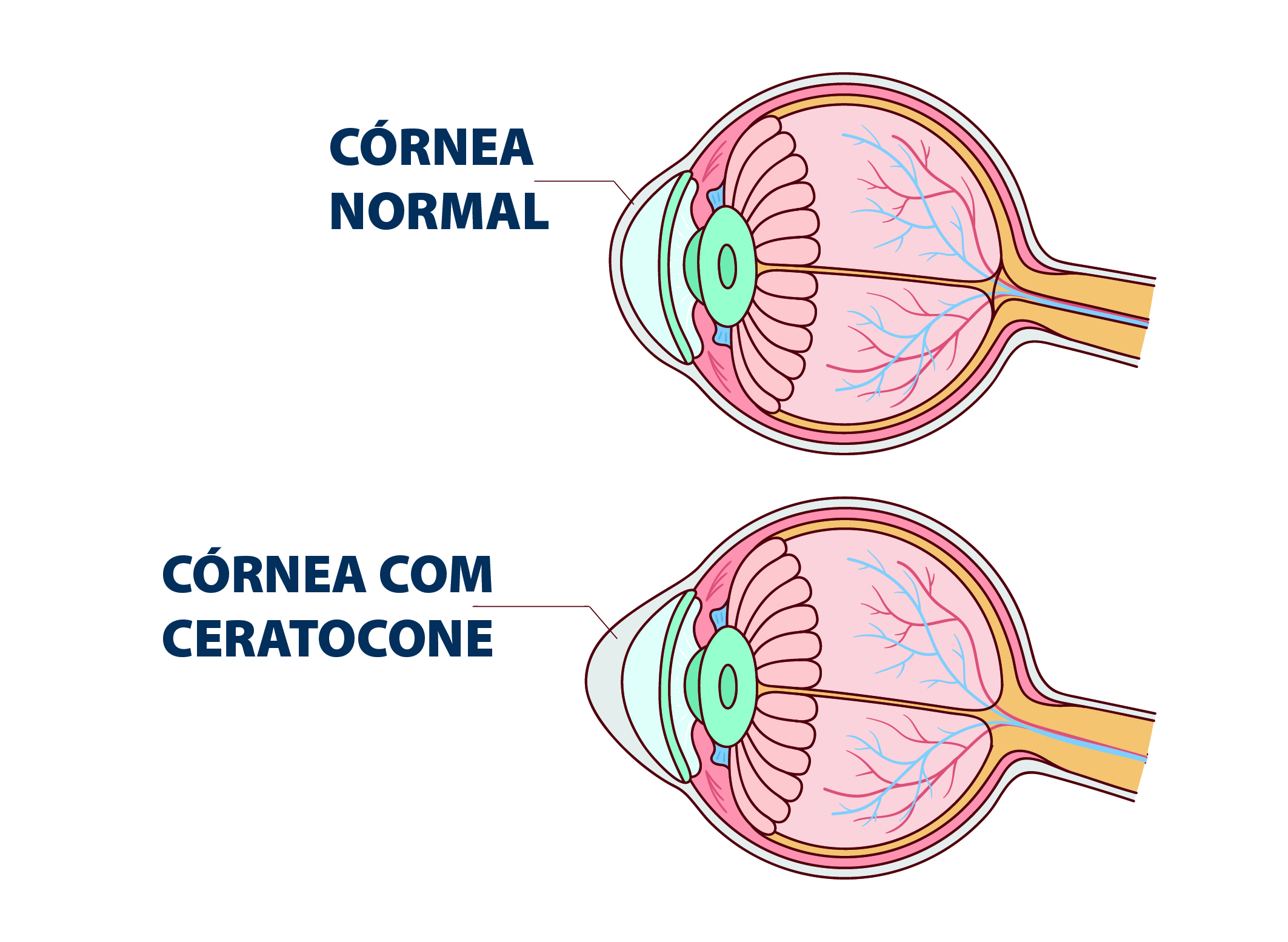 Leia mais sobre o artigo Como Funciona o Crosslinking Corneano no Tratamento do Ceratocone