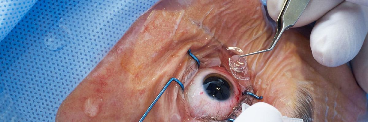 Cirurgia para astigmatismo: tipos e resultados | Médicos de Olhos