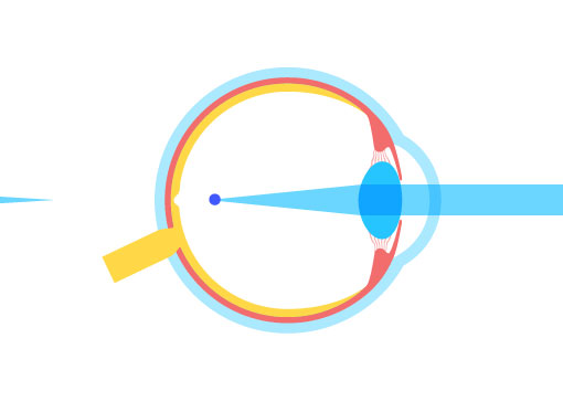 Leia mais sobre o artigo Diferença entre astigmatismo e presbiopia