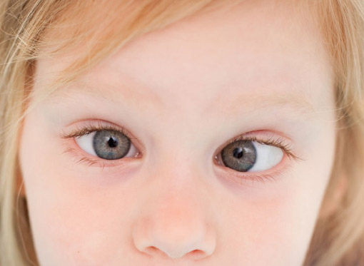 Leia mais sobre o artigo Estrabismo