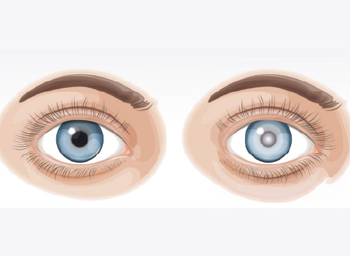 Leia mais sobre o artigo Sinais de catarata