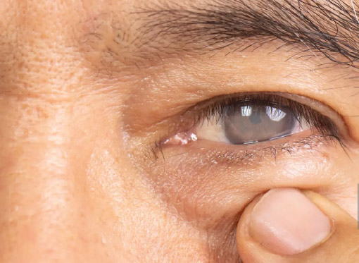 Leia mais sobre o artigo Sintomas comuns de catarata