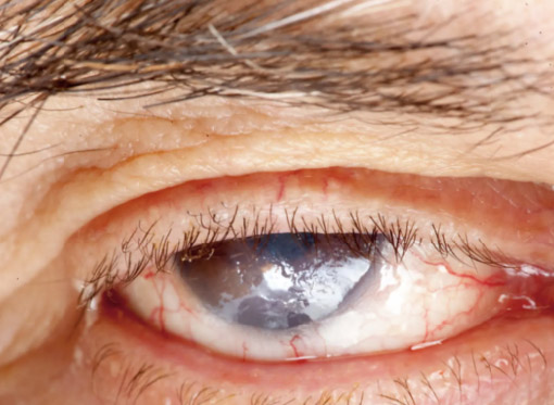 Leia mais sobre o artigo Catarata avançada tem cura? Entenda quando a cirurgia é indicada