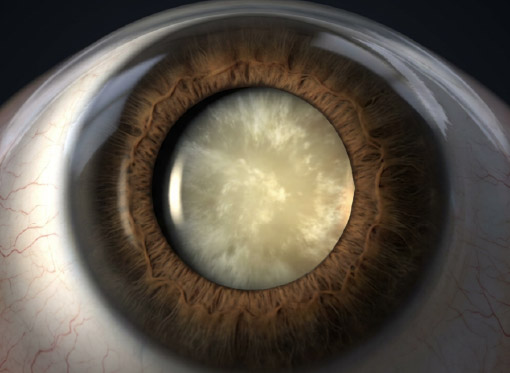 Leia mais sobre o artigo Catarata nos olhos: sintomas, causas, tratamento e quando operar