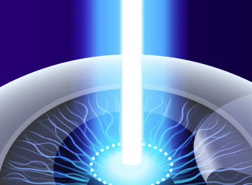 Leia mais sobre o artigo Cirurgia de miopia a laser: como funciona, quem pode fazer e cuidados